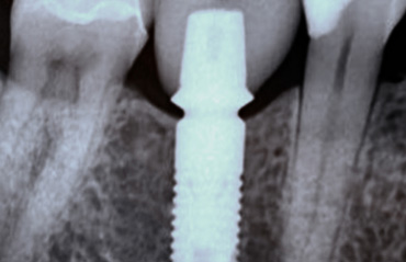X-Ray of implant post in jawbone
