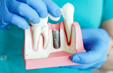 dental implant scale model
